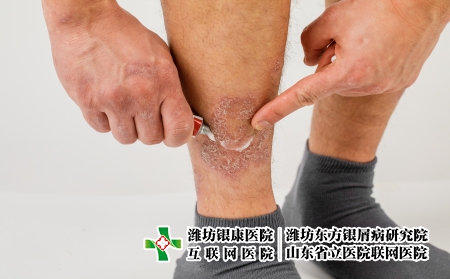 摄图网_506357587_对腿部的过敏皮疹施用治疗药膏（企业商用） (1)