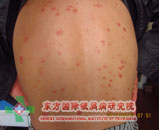 银屑病症状