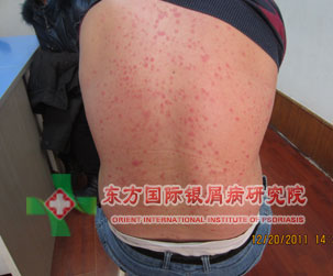 银屑病症状