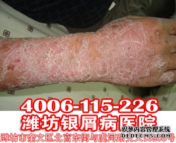 患者想要预防银屑病,要注意哪些发病原因?