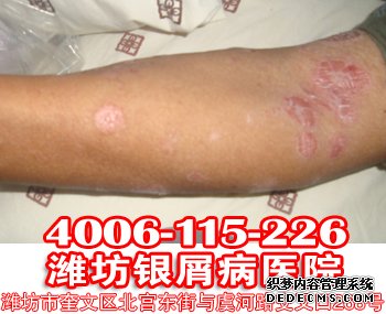 寻常型牛皮癣是不是传染病?