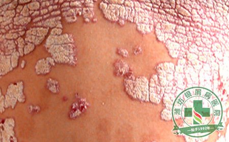 牛皮癣治疗中常见的误区有哪些