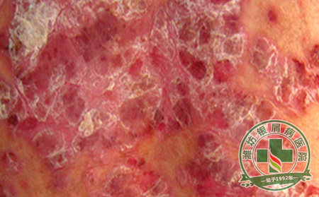 秋冬时节牛皮癣患者如何健康护理