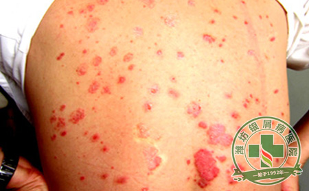 银屑病患者选择药物时应该注意什么