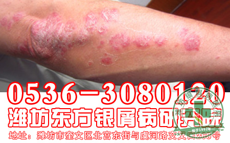 女性得了牛皮癣应该办呢?