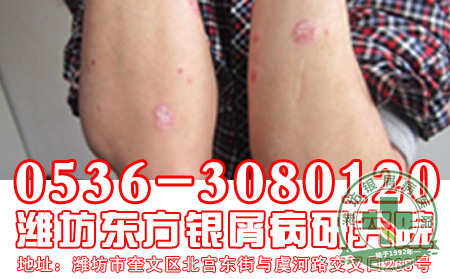 青少年牛皮癣患者在生活中要注意什么呢?