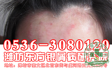 头部牛皮癣患者如何避免脱发呢?