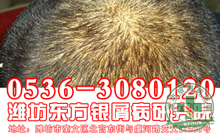 头部银屑病患者如何治疗
