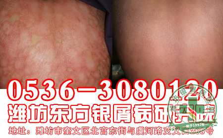医生提醒：正视银屑病才能恢复健康