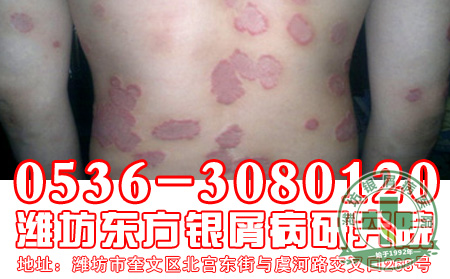 银屑病是血液方面的问题导致的吗