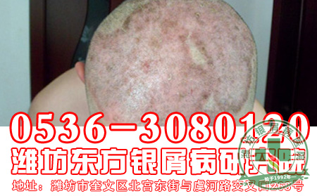 如何消除头上的银屑病