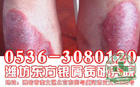 心理疗法如何治疗银屑病？