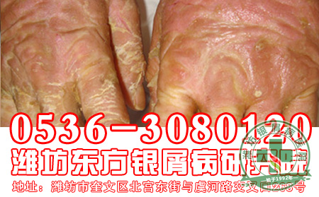 老年银屑病患者的护理禁忌