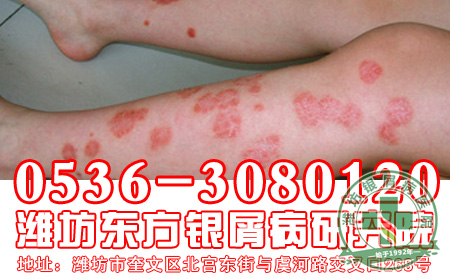 医生提醒银屑病患者小心感冒