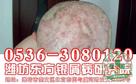 治疗银屑病要避开的误区有哪些