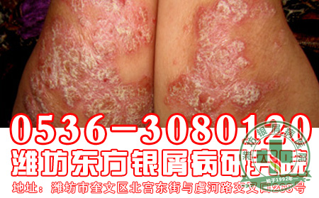 怎样预防银屑病皮损扩散