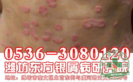 银屑病患者如何健康睡眠