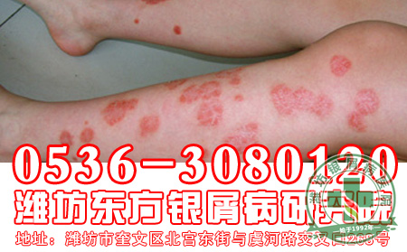 秋季,银屑病患者如何避免蚊虫叮咬?