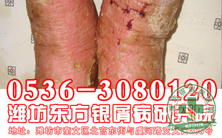 关节型银屑病容易找上女性的原因