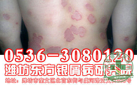 医生提醒:居住环境也会影响到银屑病患者