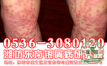 银屑病患者正确用药很关键