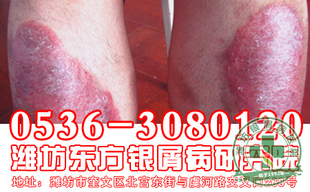 银屑病治疗的有效药有哪些