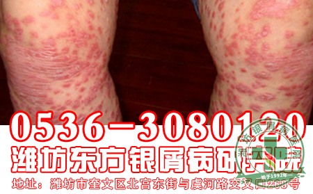 消退期银屑病治疗注意事项