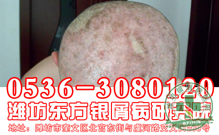 头部银屑病患者如何有效止痒