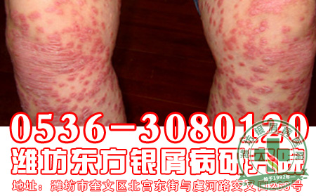 银屑病患者居住环境要求