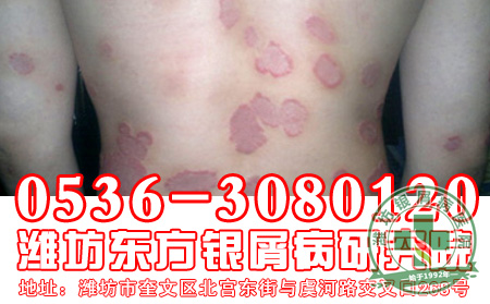 银屑病秋季护理怎么进行