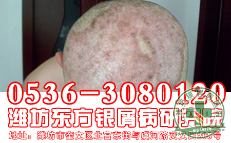 银屑病容易找上哪些人?