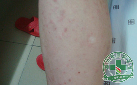患者关注：怎样可以降低银屑病的遗传几率？