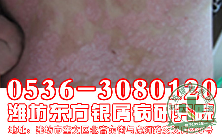 秋季银屑病患者养生之橘络的妙用