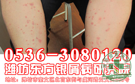 医生忠告：牛皮癣患者请不要放弃治疗