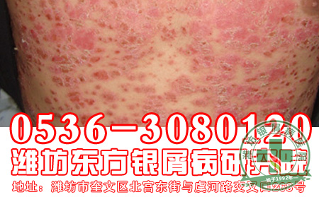 红皮型牛皮癣治疗期间应该注意哪些问题?