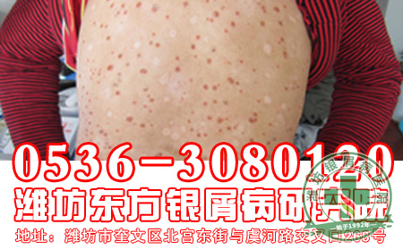 脓疱型牛皮癣常见的危害有哪些？