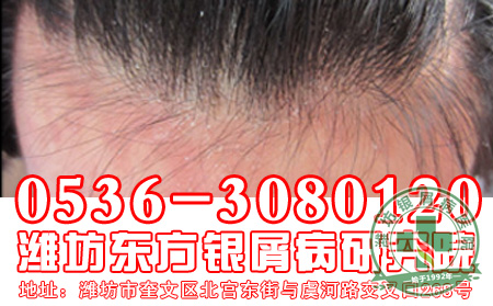 寻常型银屑病会恶化为重症银屑病吗？
