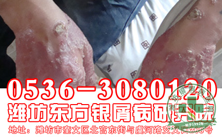 临床上，关节型银屑病有哪些分类？