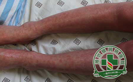 牛皮癣患者如何摆脱静电实现健康