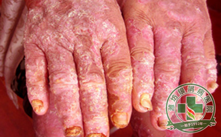 老年牛皮癣患者的护理应该注意什么