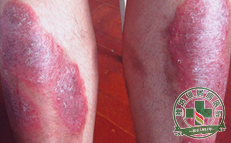 儿童得了牛皮癣怎么办