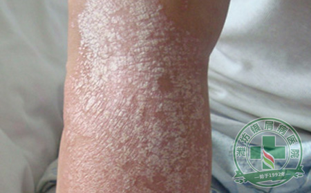 关于银屑病治疗,我们有话说