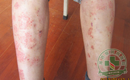 银屑病患者应该怎样调整心理状态？