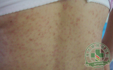 预防银屑病复发的常见措施有哪些?