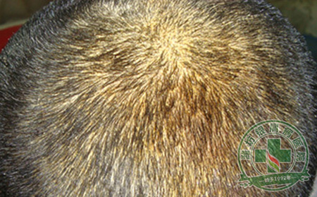 潍坊银屑病医院教你正确护理银屑病