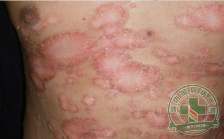 秋季来临,银屑病患者应该注重运动养生