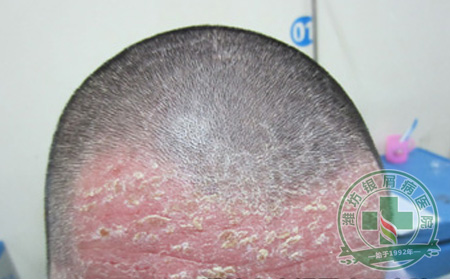 头皮型银屑病有什么症状表现?