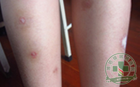 医生浅谈银屑病患者运动“误区”