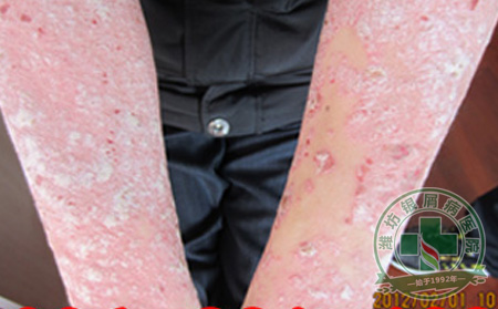 银屑病患者警惕“毒水果”