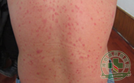 银屑病父系遗传和母系遗传